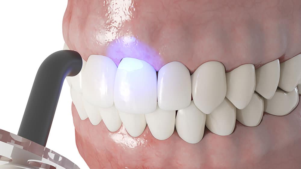 Affordable dental bonding