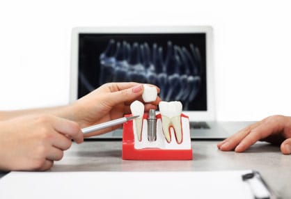 dental implants Toronto