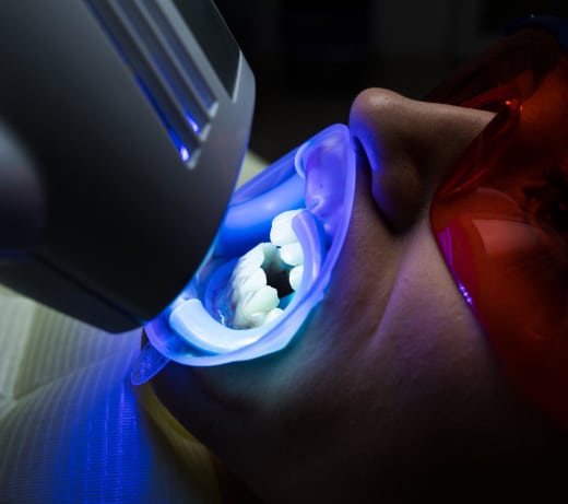 Zoom Whitening Toronto ON