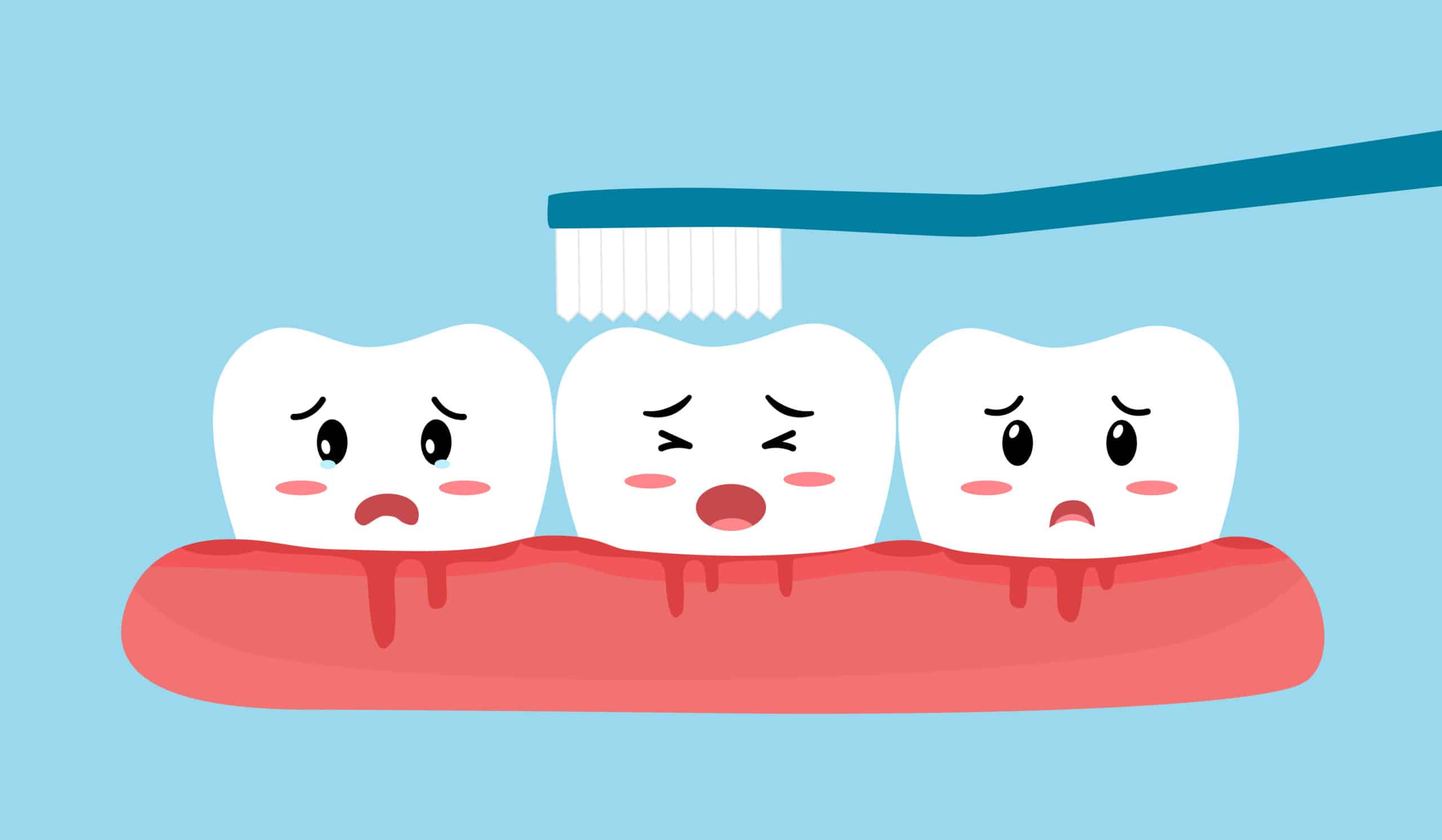 Gums Bleed When Brushing